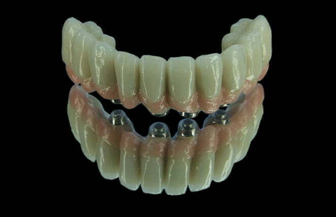 , Dental Implants